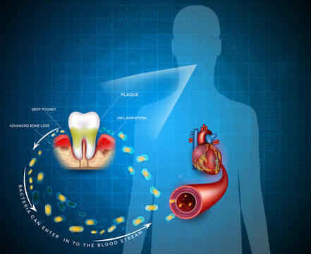 Gum disease inflammation bacteria can enter in to the blood stream an affect heart.  Periodontitis disease disease anatomy on an abstract blue background