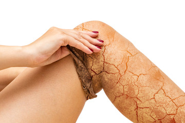 girl takes off her pantyhose with dry skin. Cracks in the skin of the legs. Concept 2
