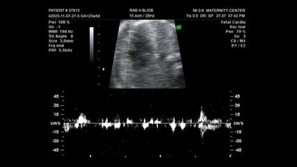 Ultrasound cardiography heart beats