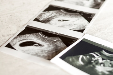 Photographs of ultrasound of pregnancy at 4 weeks and 20 weeks of pregnancy. Selective focus
