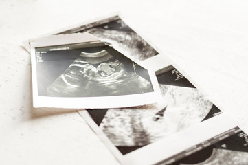 Photographs of ultrasound of pregnancy at 4 weeks and 20 weeks of pregnancy. Selective focus