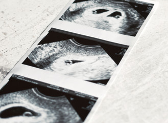 Snapshot of twins on the ultrasound at the stage of embryos. Ultrasound of multiple pregnancy in the fourth week. Selective focus.