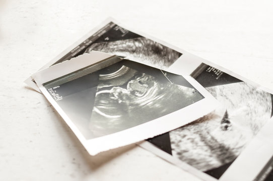 Photographs of ultrasound of pregnancy at 4 weeks and 20 weeks of pregnancy. Selective focus