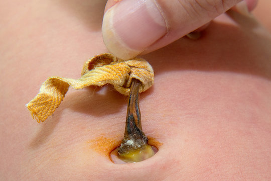 Close up of navel newborn baby boy. Close up umbilical cord .