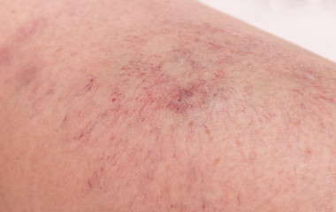 Footprint on the skin from vascular dilatation of veins, vascular pattern on human skin, close-up, phlebeurysm, capillaries, medical