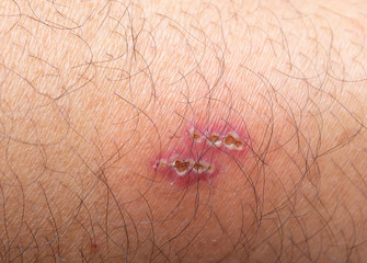 Wound infection on the skin, Skin lesions, Impetigo, Ecthyma