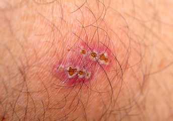 Wound infection on the skin, Skin lesions, Impetigo, Ecthyma