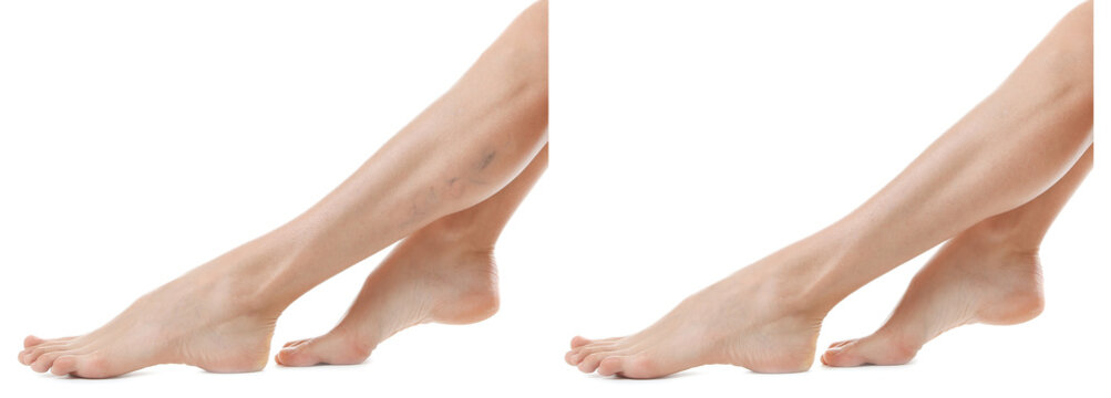 Young woman before and after varicose treatment against white background, focus on legs