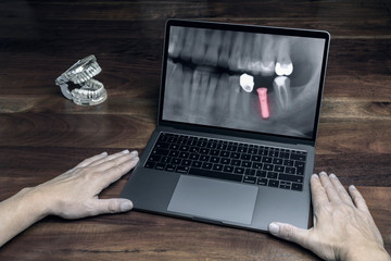 Auf dem Computer eine Röntgenaufnahme über ein Implantat
