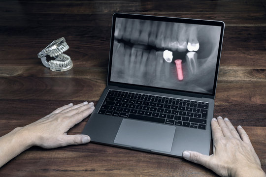 Auf dem Computer eine R&ouml;ntgenaufnahme &uuml;ber ein Implantat