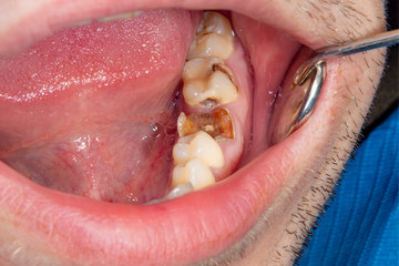 Dental caries. Filling with dental composite photopolymer material using rabbders. The concept of dental treatment in a dental clinic
