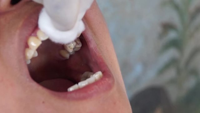 dental tooth extraction