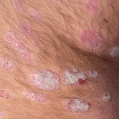 Fototapeta premium Psoriasis on the human body, close-up