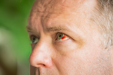 Close up of man with broken blood vessel in eye. Subconjunctival bleeding