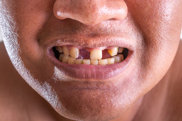 Close-up of young man with a teeth broken.