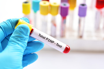 Blood sample tube for total P1NP test, diagnosis for bone disease
