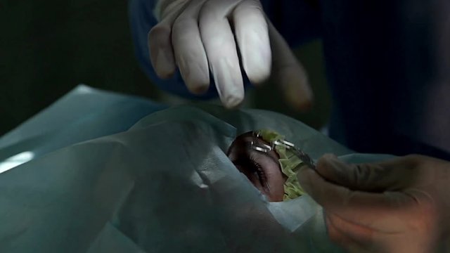 doctor sets on eye blepharostat, The operation on the eye, Cataract surgery, blepharostat on the eye, Ophthalmologist in the operating room