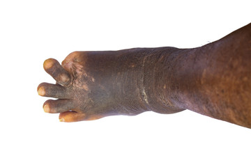 Diabetic medical scheme with common foot conditions have ulcers isolated on white background.