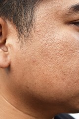 pores and oily on surface young asian man face skin do not take care for a long time