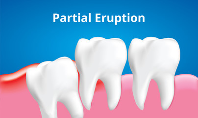 Wisdom tooth ( Partital Eruption ) with inflammation affect , Dental care concept, Realistic illustration Vector