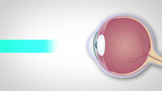 Schematic representation of hyperopia, myopia and astigmatism, Correction of various eye vision disorders by lens. Hyperopia, myopia and astigmatism
