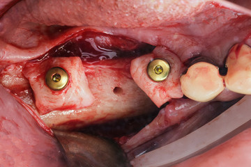 implantation and soft tissue build-up in the gum of the jaw