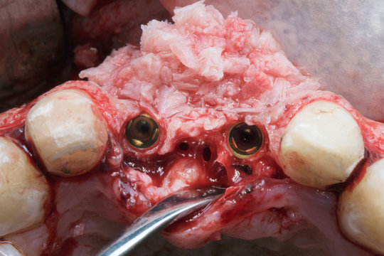 buildup of tissue after implantation using a natural bone Paci
