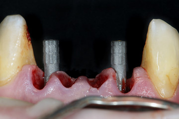 Dental Surgery accurate restoration gums and fixed abutments
