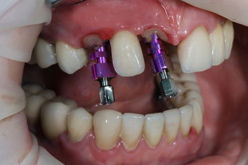 Obraz premium individual abutments bright color before installation of crowns of the upper jaw