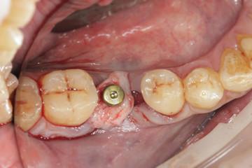 plug Dental implant and soft tissue buildup