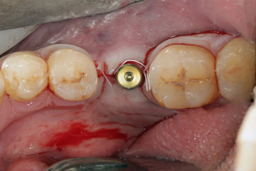Obraz premium plug after imlantirovaniya Dental chewing on parts