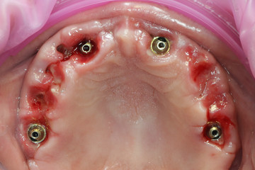 reduction of the crest and buildup of soft tissue with artificial membranes