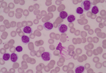 Blast cells on red blood cells background.