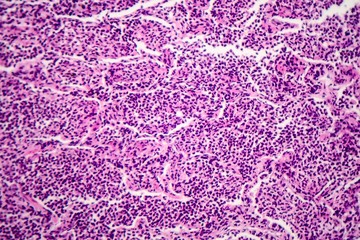 Histopathology of interstitial pneumonia