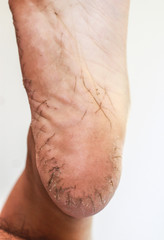 Naklejka premium Broken foot skin