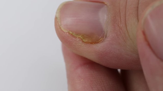 Close up of nail fungus infection on the thumb finger. Fungal infection on nails hand, finger with onychomycosis, damage on human hand