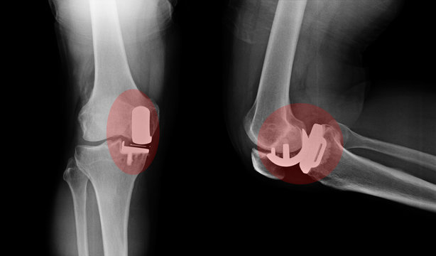 knee x-rays image showing plate and screw fixation