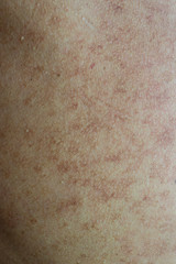 Some skin diseases on the skin.