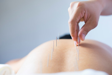 acupuncture treatment - obrazy, fototapety, plakaty