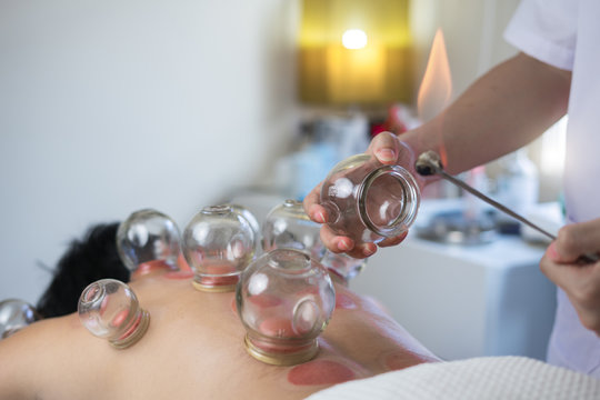 cupping therapy 2