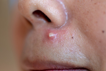 Fototapeta premium Backgrounds of lesions skin caused by acne on the face in the clinic.