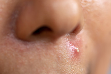 Backgrounds of lesions skin caused  by acne on the face in the clinic.