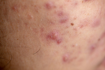 Fototapeta premium Backgrounds of lesions skin caused by acne on the face in the clinic.