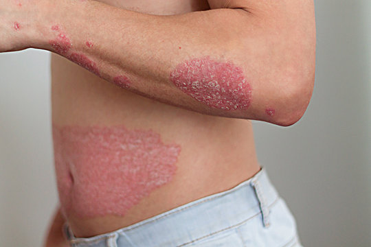the man on the arm and abdomen psoriasis