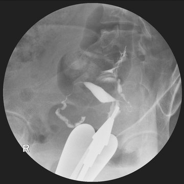 Hysterosalpingography (HSG) is a fluoroscopic study of a woman's uterus and fallopian tubes.