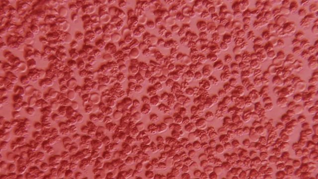 Red Blood with Burr Cells 600x Phase Microscope