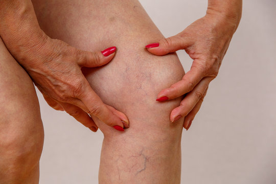 An elderly woman in white panties is touching her legs with cellulite and varicose veins on a light isolated background. Concept for medicine and cosmetology.