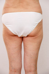 An elderly woman in white panties shows places on the body with cellulite and varicose veins on a bright isolated background. A concept for medicine and cosmetology.