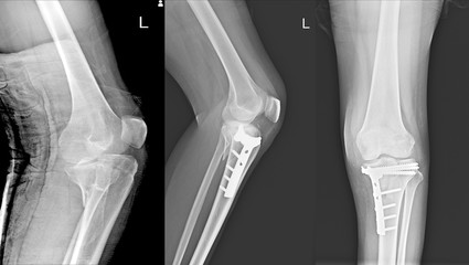 X-ray Knee Joint Fracture proximal tibia and Post fix fracture proximal tibia.