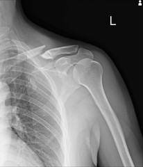 Chest x-ray Fractures left clavicle, anterior 2nd rib, posterior rib 4,5  and lateral aspect of left 6 th rib. - obrazy, fototapety, plakaty
